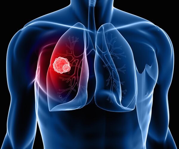 I Smoked: Should I Get Screened for Lung Cancer?