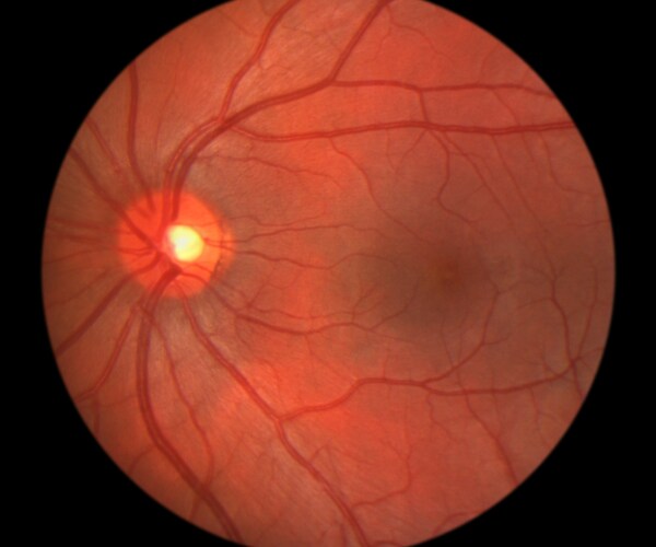 A view inside the eye of the retina and optic nerve