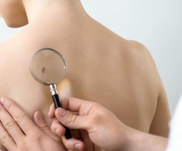 Doctor looking at suspicious mole on woman's back through a magnifying glass.