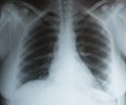 High Viral Load in Lungs Drives Fatal COVID-19: Study