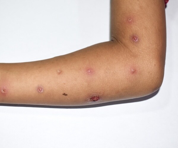 crusted monkeypox skin lesions over the arm of asian child