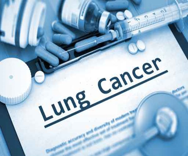 Lung Cancer Breathalyzer in Clinical Trials