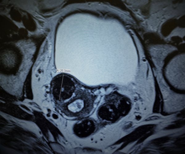 Less Invasive Fibroid Treatment May Work Better Than Surgery