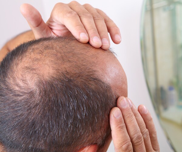 a man looking at his head with thinning hair