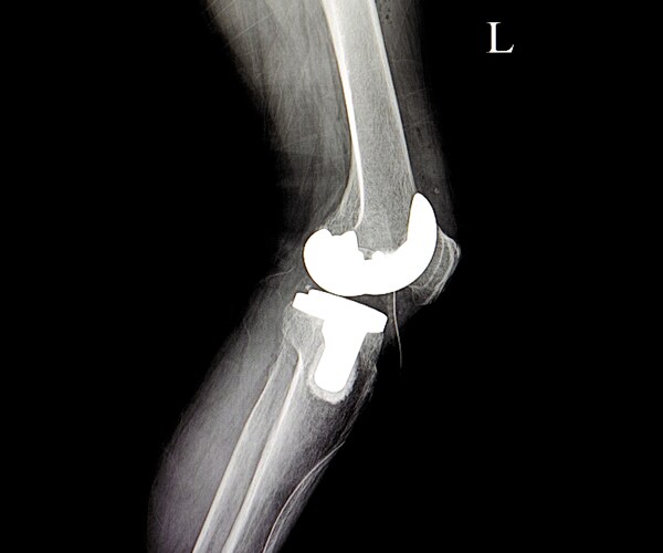 an x-ray showing a total knee replacement