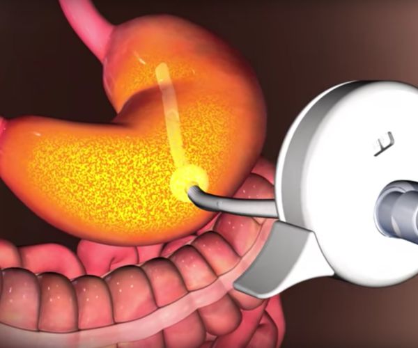 FDA: Stomach Pump Approved to Help Obese Offload Food Before Digestion