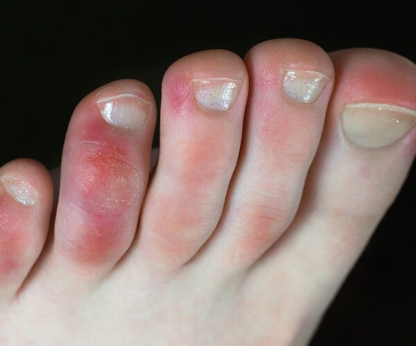 close-up of a person's toes that have a red rash as a reaction to COVID-19 infection