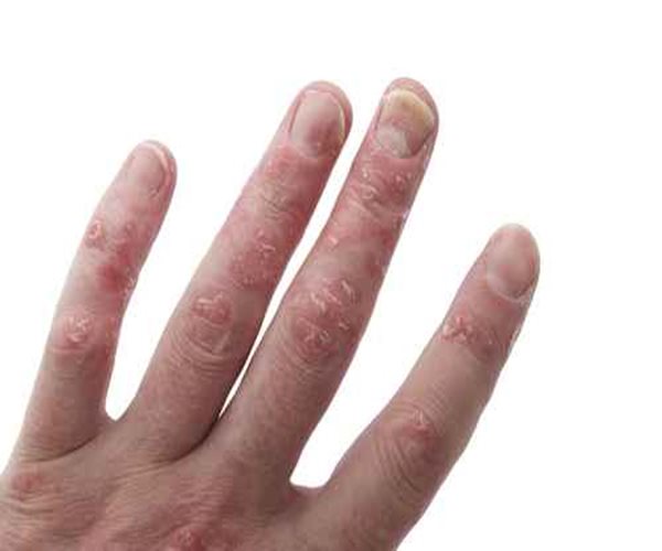 Psoriasis May Raise Risk of Abdominal Aneurysms