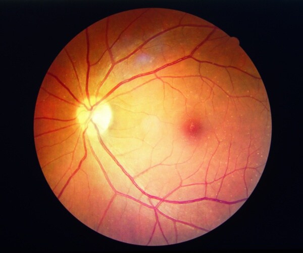 closeup of an eye with diabetic retinopathy