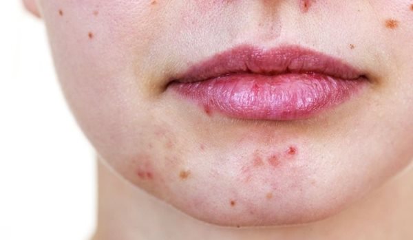 woman's face with acne on her chin