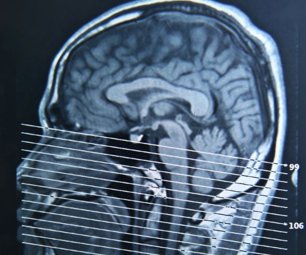 Concussion Tied to Suicide Risk