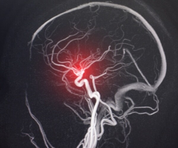 6 Ways to Reduce Stroke Risk