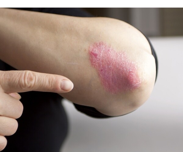an elbow the psoriasis