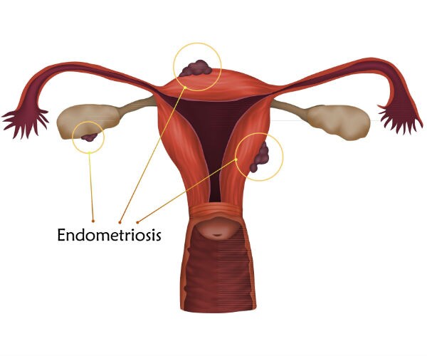 illustration shows the layer of tissue that normally covers the inside of the uterus and grows outside of it.