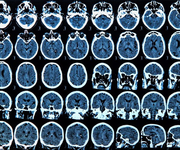 results from a brain MRI