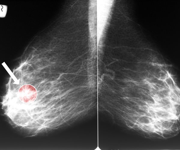 image of breasts, one with breast cancer
