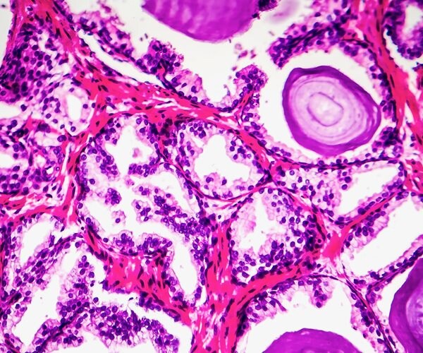 Natural Ways to Shrink an Enlarged Prostate