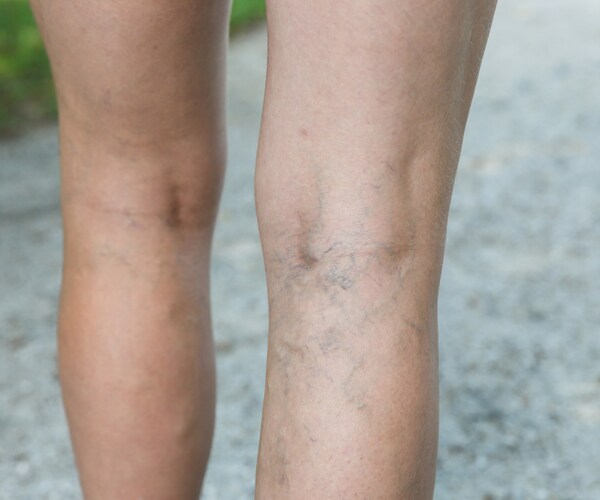 Varicose veins