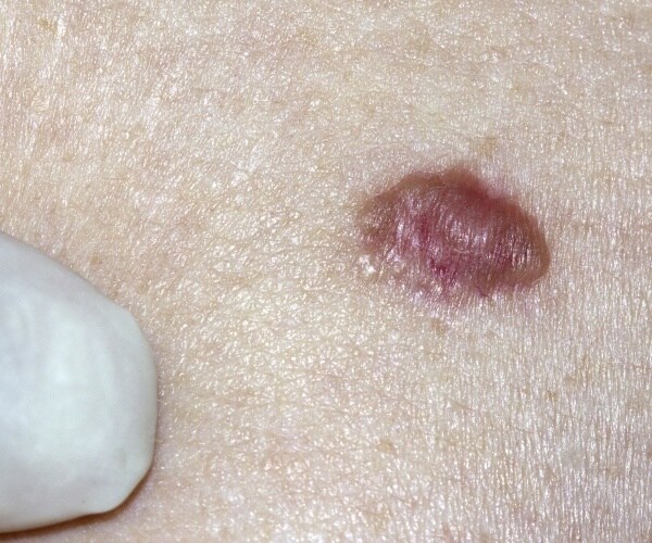 dermatologist examining a basal cell carcinoma on a patient