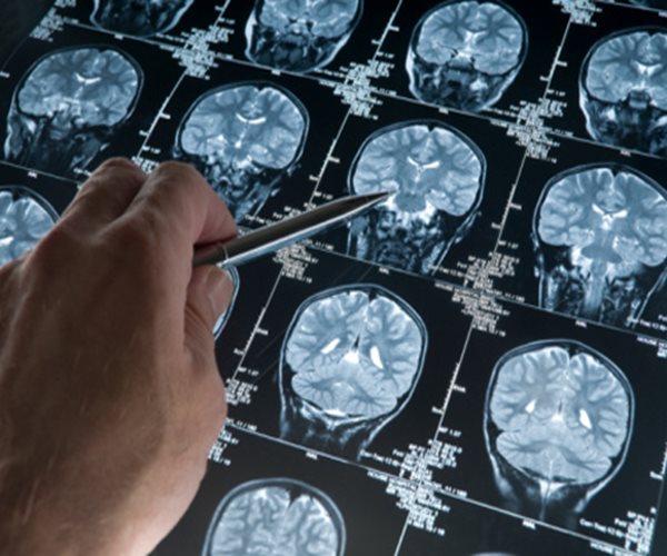 Brain Scans May Improve Epilepsy Surgery