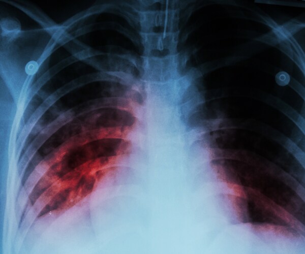 a lung x-ray showing tuberculosis