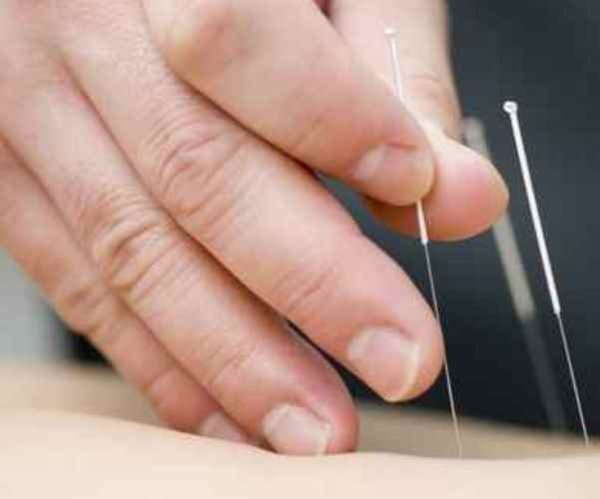 Acupuncture Lowers Blood Pressure in Trial