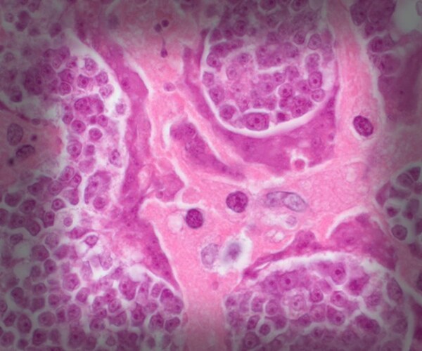 Tapeworm Cancer: Malignant Cells Can Transfer From Parasites to Humans