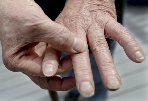 Hands afflicted with rheumatoid arthritis.
