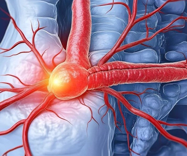 illustration of an abdominal aneurysm