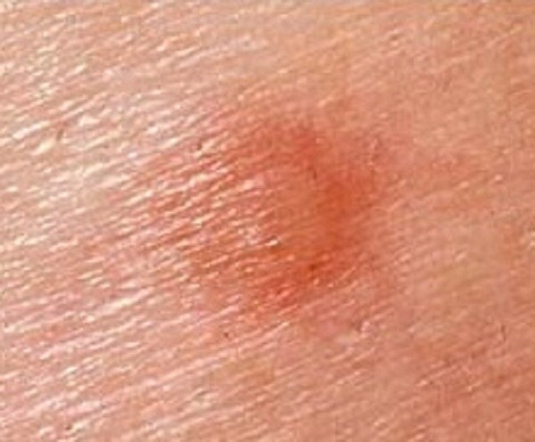 Oregon Teenager Diagnosed with Bubonic Plague 