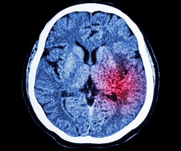 a brain scan showing the location of a stroke