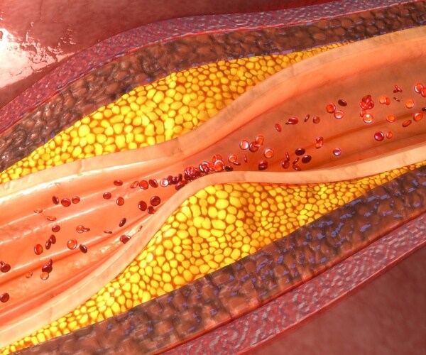 illustration of plaque buildup in arteries