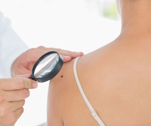 Melanoma Rates Triple; How to Protect Yourself