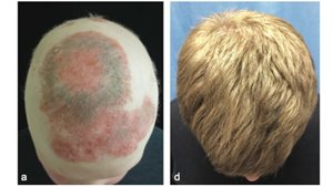 Arthritis Drug Spurs Hair Growth - Lots of It