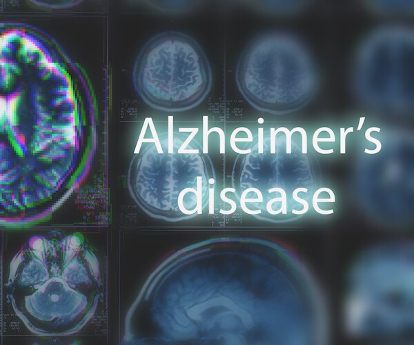 A graphic illustration with the words Alzheimer's Disease on it