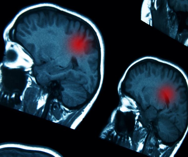 Brain Problems Linked to Even Mild Virus Infections: Study 