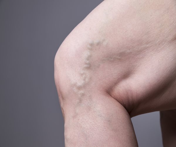 Varicose Veins Raise Odds of Blood Clots