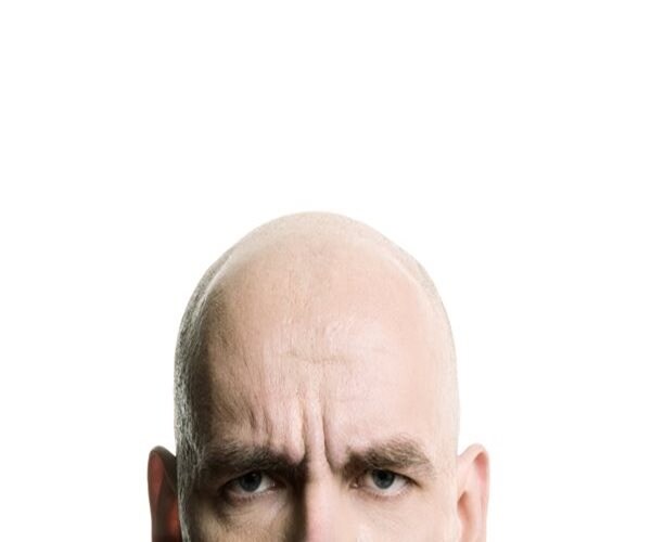 Short, White Men More Likely to Go Bald: Study