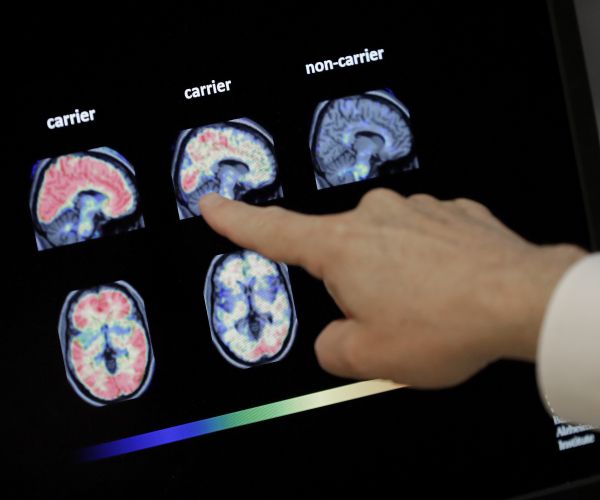 Doctors Unprepared for Surge in Alzheimer's Cases