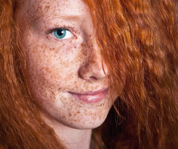 Skin Cancer Risk for Freckly Redheads Equivalent to 21 Years in Sun