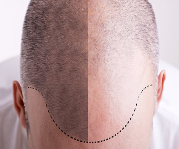 Hair Transplants Make Men Look Younger: Survey