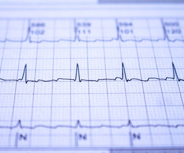 print out of electrocardiogram showing arrhythmia 