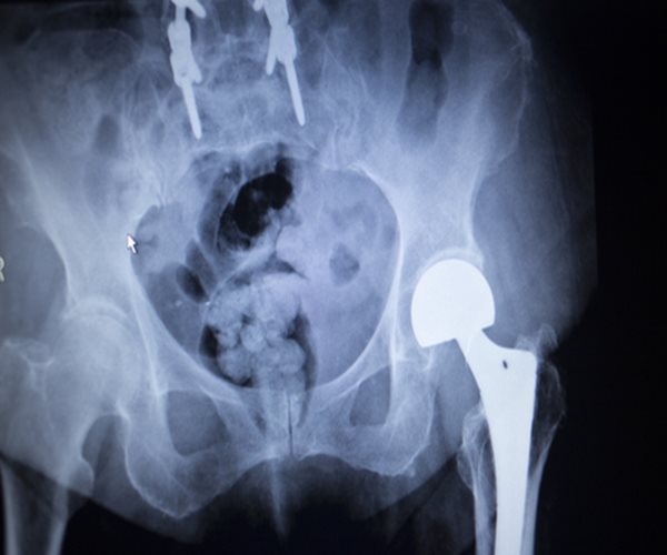 New Hip May Add to Lifespan