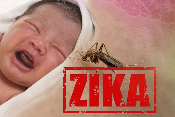 US Health Authorities Confirm Zika Causes Birth Defects