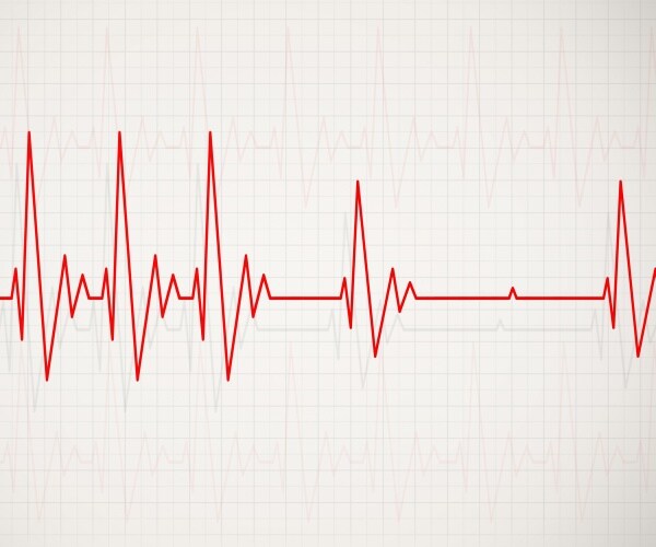 illustration of an EKG of an irregular heartbeat