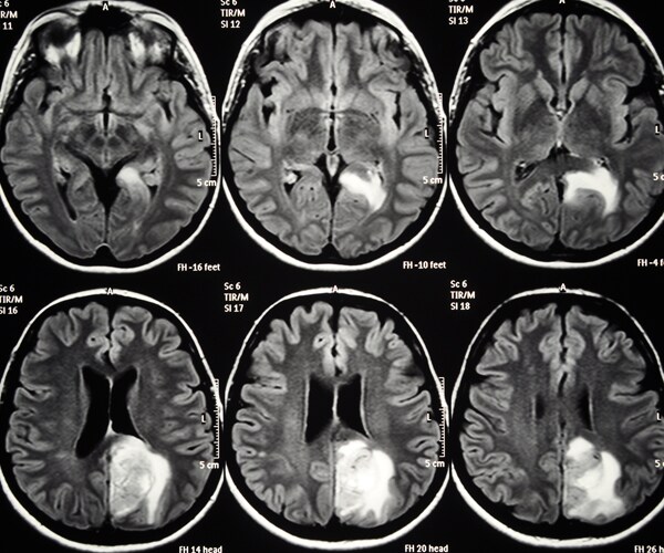 a brain scan showing a glioblastoma brain tumor