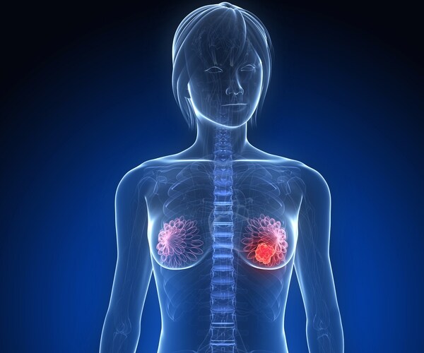 Trial Offers New Hope for Breast Cancer Vaccine