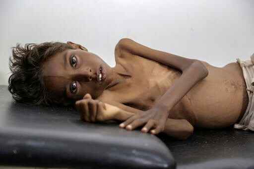 Yemen's Children Starve as war Drags on
