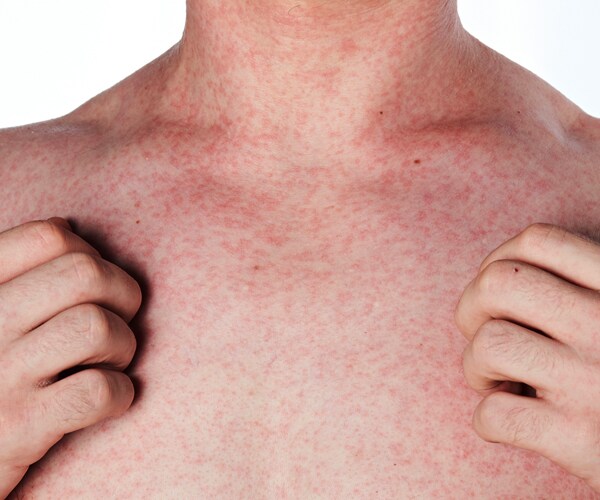 Fiery Rash Breaks Out in Smoky California Burb