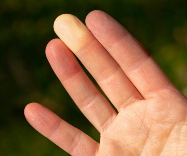 a person's hand with Raynaud's phenomenon with two fingertips that are white
